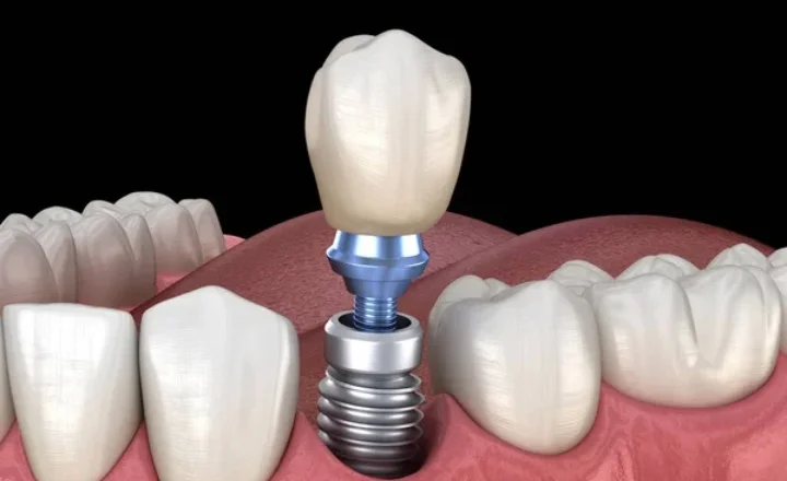 Dental Implant in pune