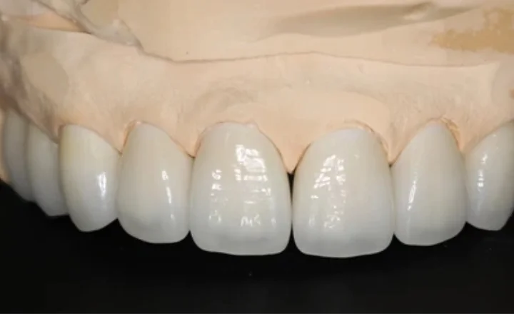 Zirconia Crown in pune