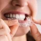 invisible braces treatment